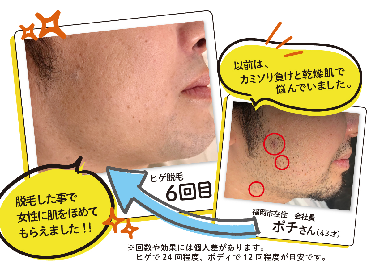 以前は、カミソリ負けと乾燥肌で悩んでいました。お客様情報福岡市在住　会社員ポチさん（43才）ビフォーアフターヒゲ脱毛 6回目※回数や効果には個人差があります。ヒゲで24回程度、ボディで12回程度が目安です。脱毛した事で女性に肌をほめてもらえました！！